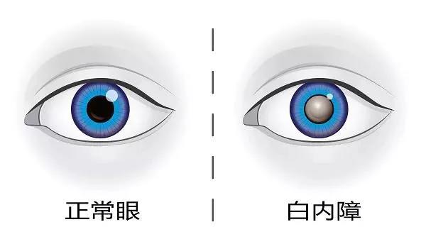 眼睛退化不用怕！白內(nèi)障手術(shù)“辭舊迎新”，讓老年人想怎么看就怎么看！