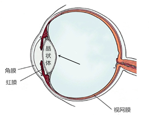 不要怪身體沒“警告”你，白內障初期有這五大癥狀