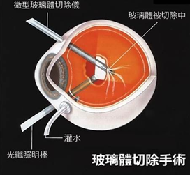 劇烈運(yùn)動(dòng)還會(huì)導(dǎo)致視網(wǎng)膜脫落？高度近視人群要小心了
