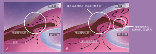 會導致嚴重受損的三大致盲性眼病你都知道嗎？