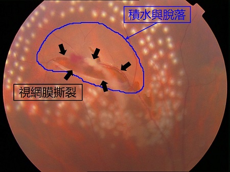 這層膜很重要，視網膜脫落之后極危險