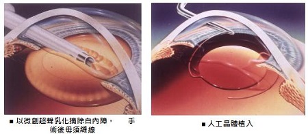 白內(nèi)障手術(shù)