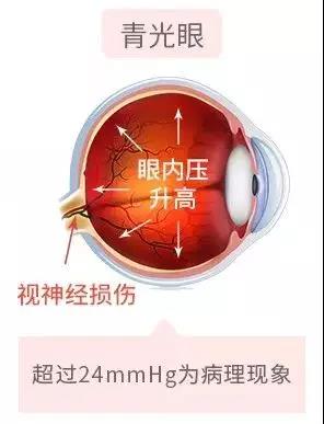 濫用眼藥水，當心青光眼找上門！