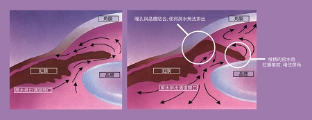 急性青光眼并發癥