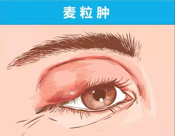 眼睛腫了，到底應該熱敷還是冷敷？這次終于解釋清楚了！