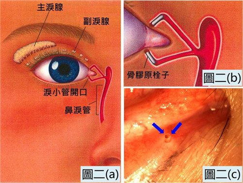 淚小點(diǎn)封閉手術(shù)治療干眼癥