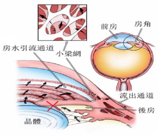 青光眼和白內障，這對難兄難弟是如何互相影響的?