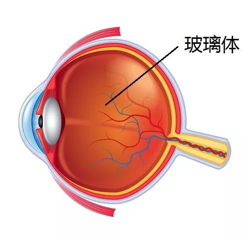 高度近視為什么會引起視網膜脫落呢？