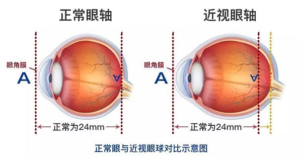高度近視為什么會引起視網膜脫落呢？