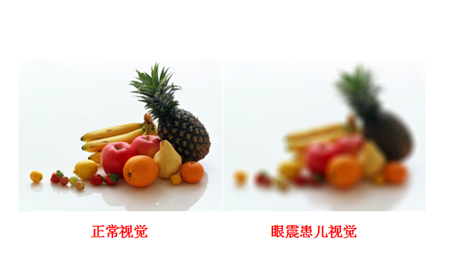 眼球震顫對視力的影響