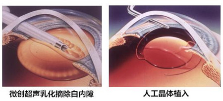 白內(nèi)障手術(shù)