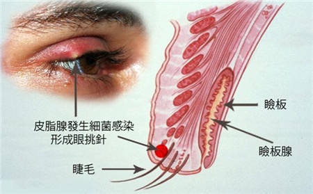 麥粒腫發(fā)生原因