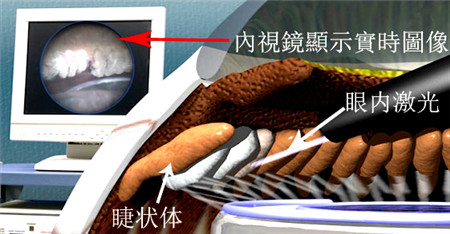 內(nèi)視鏡下睫狀體光凝固術