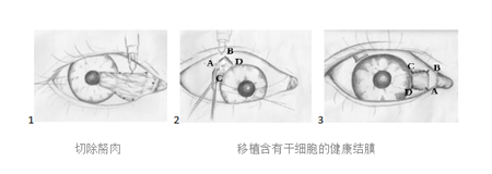 翼狀胬肉切除手術