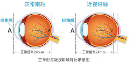 戴眼鏡會導致近視度數上漲嗎