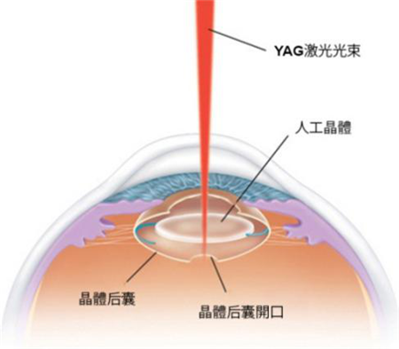 北京治療后發(fā)性白內(nèi)障