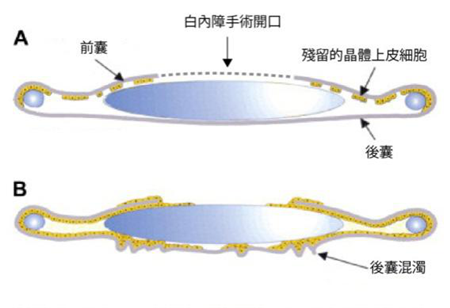 白內(nèi)障術(shù)后復(fù)發(fā)怎么辦