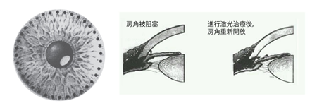 北京青光眼治療哪個醫院好