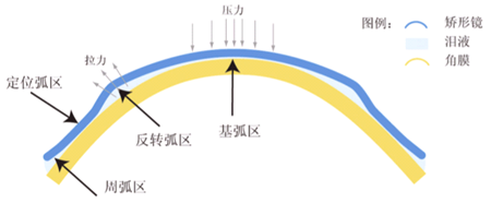 ok鏡是如何矯正視力的？